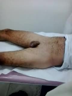 Pic #1M* Epilation