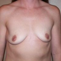 Pic #1 New Boobs