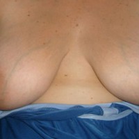 Pic #1 Huge Tits